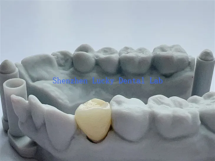 Print 3d China esthetig deintyddol llawn cyfuchlin zirconia coron zirconia