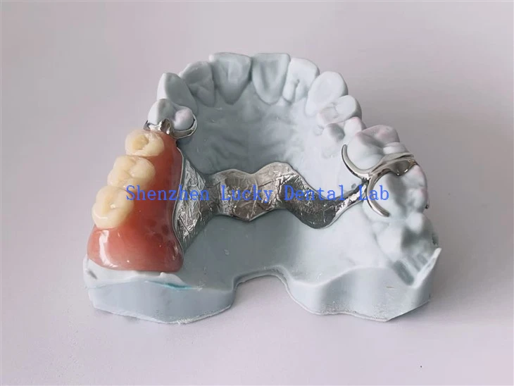 Fframwaith metel cocr deintyddol print 3d gyda chlasp aker dwbl