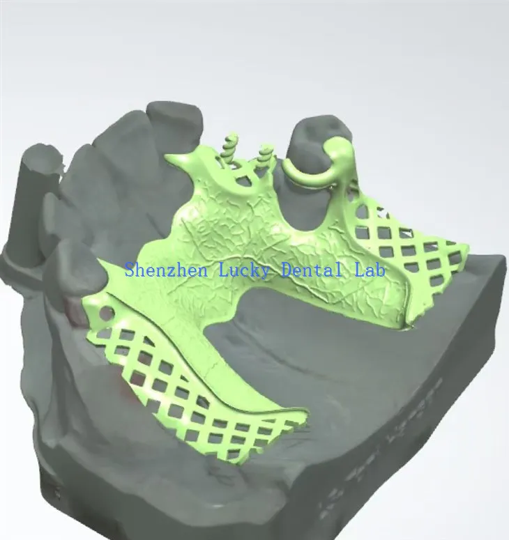 Gwneuthurwyr Fframwaith Metel Deintyddol Argraffu 3D