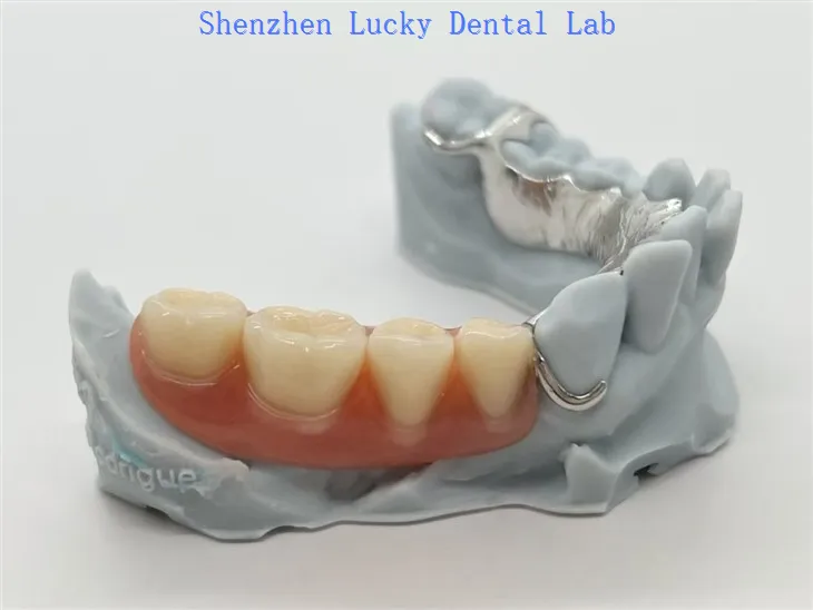 3D Argraffu Metal Co Cr Fframwaith Gyda Acrylig Dannedd gosod