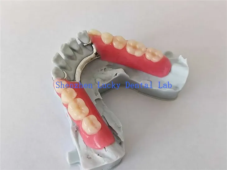 Print 3D Dannedd gosod acrylig rhannol gyda fframwaith metel ceisiwch mewn labordy deintyddol