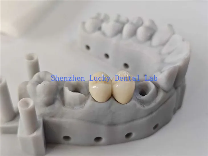 Pont Cocr PFM Deintyddol Esthetig