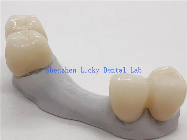 Pont Zirconia Deintyddol Esthetig