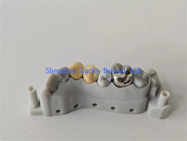 Print esthetig 3d print fmc a pfm cocr coron wedi'i wneud yn Tsieina