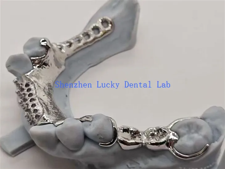 Dyluniad dannedd gyda chefnogaeth aloi gyda fframwaith metel