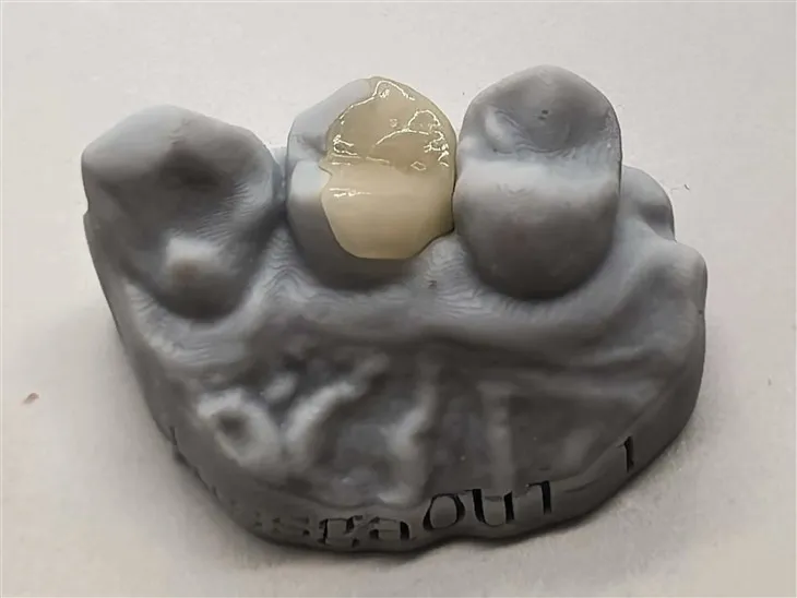 Onlay Cyfansawdd Dilys Am Bris Gwell