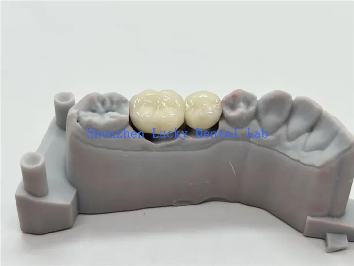 CoCr Aloi Coronau Deintyddol PFM