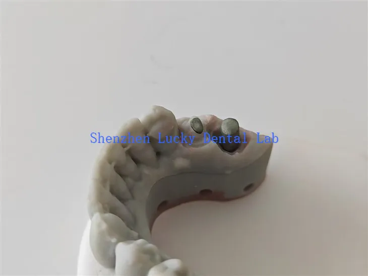 Labordy deintyddol post deintyddol print 3D wedi'i addasu