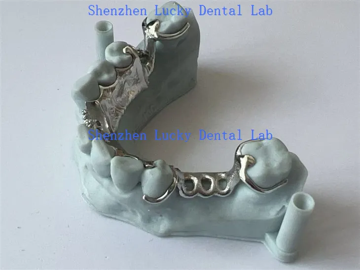 Fframwaith metel print 3D gyda labordy deintyddol plât dwyieithog