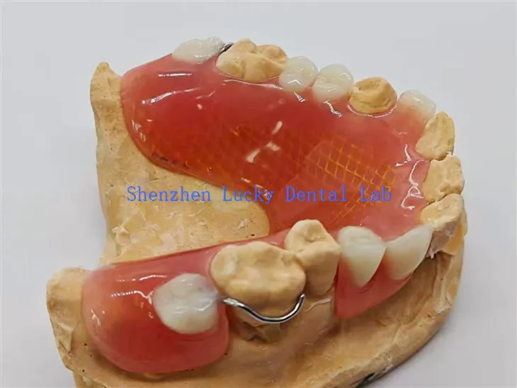 Dannedd gosod rhannol symudadwy gyda rhwyll fetel