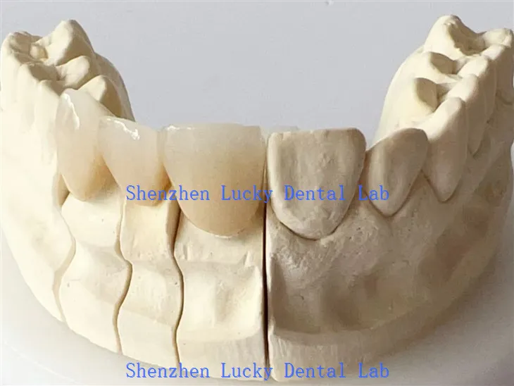 Deintyddol Contour Llawn Zirconia Crown Lab Deintyddol