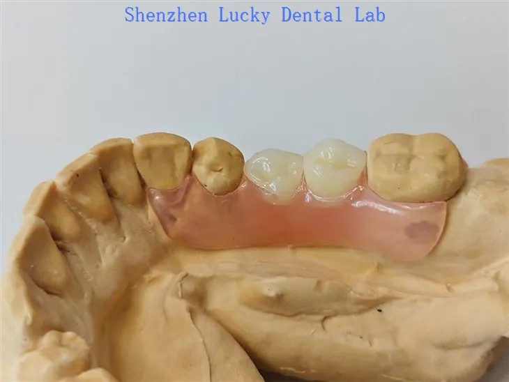 Dannedd gosod deintyddol hyblyg rhannol gyda gweithgynhyrchwyr clasp valplast