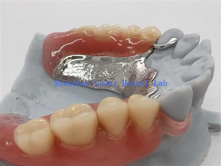 Fframwaith metel clasp valplast gyda dannedd gosod acrylig