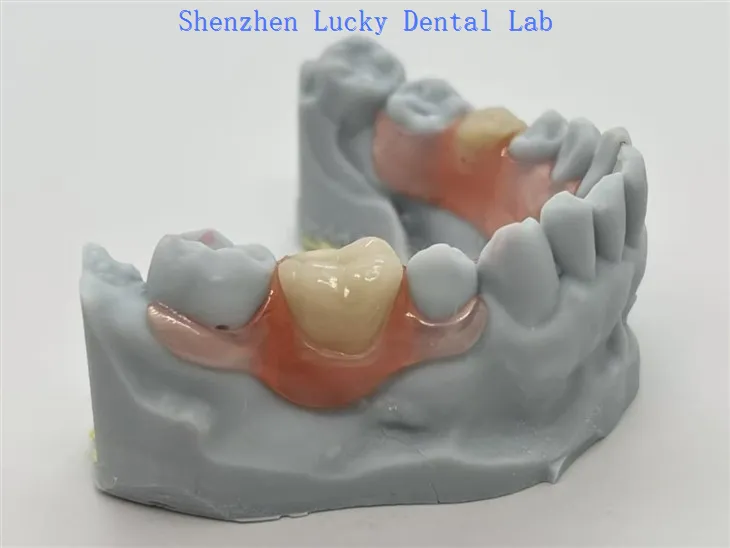 Rhaniadau Valplast® gyda clasp hyblyg