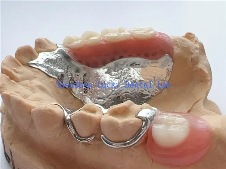 Fframwaith metel deintyddol clasp gwifren gyda dannedd gosod acrylig rhannol